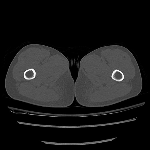 Normal pelvis CT (Radiopaedia 51471-57236 Axial bone window 109).jpg