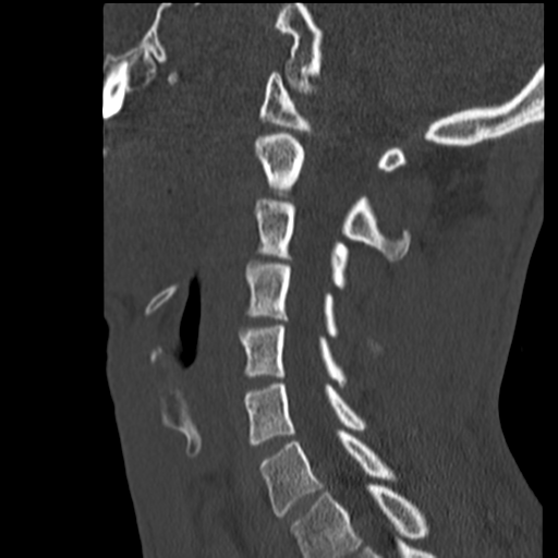 File:Normal trauma cervical spine (Radiopaedia 41017-43760 Sagittal bone window 29).png