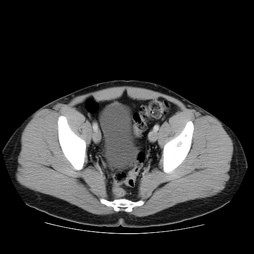 File:Obstructing ureteric calculus (Radiopaedia 18615-18514 B 48).jpg