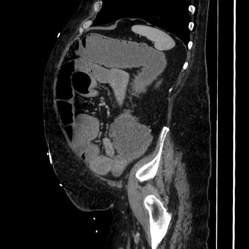 Obstructive colonic diverticular stricture (Radiopaedia 81085-94675 C 178).jpg