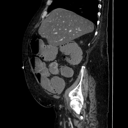 Obstructive colonic diverticular stricture (Radiopaedia 81085-94675 C 74).jpg