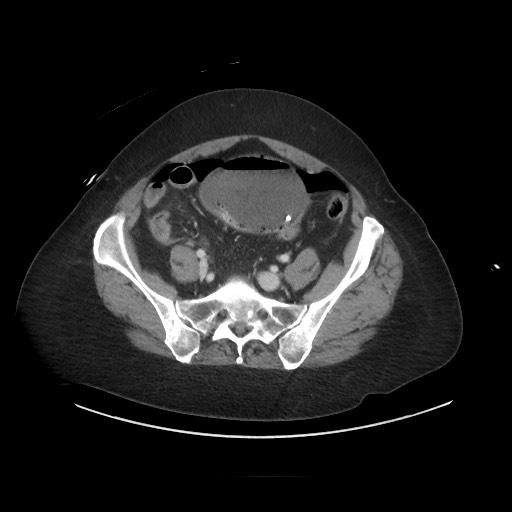 Obstructive distal colonic adenocarcinoma causing cecal perforation (Radiopaedia 86830-102989 A 146).jpg