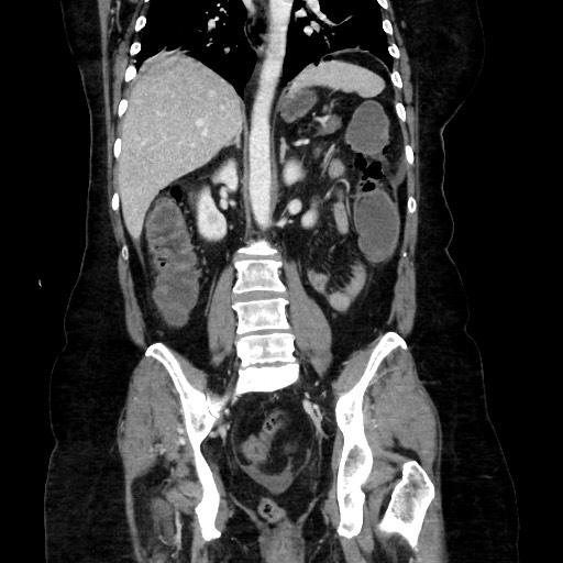 Obstructive distal colonic adenocarcinoma causing cecal perforation (Radiopaedia 86830-102989 C 114).jpg
