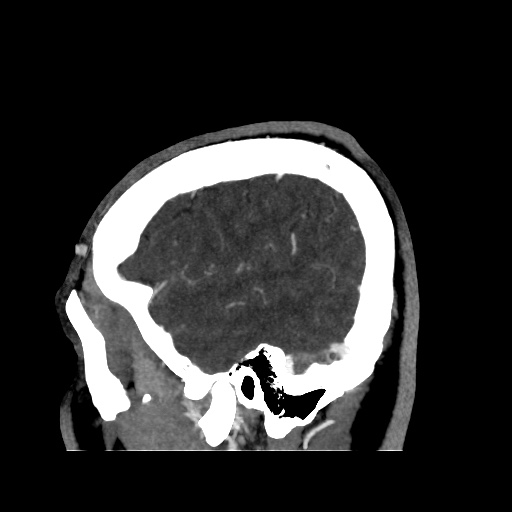 Occipital extradural hematoma simulating venous sinus thrombosis (Radiopaedia 46514-50964 D 13).jpg