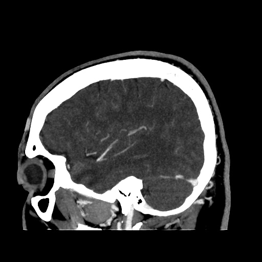 Occipital extradural hematoma simulating venous sinus thrombosis (Radiopaedia 46514-50964 D 20).jpg