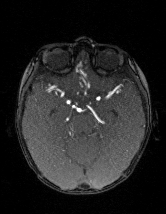 Occipital horn syndrome (Radiopaedia 14255-14129 MRA 61).jpg