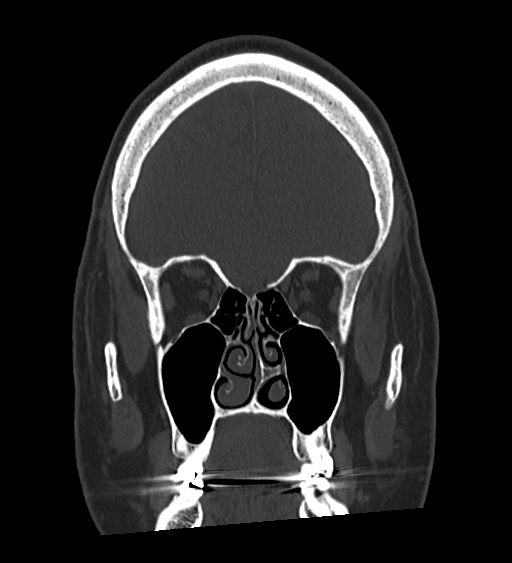 Occipital spur and Currarino type A atlas anomaly (Radiopaedia 87027-103285 Coronal bone window 50).jpg