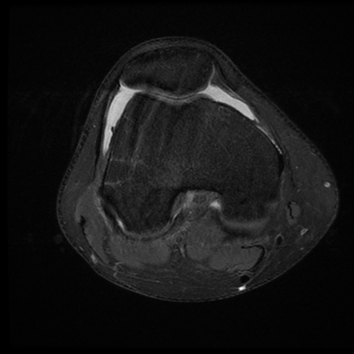 File:ACL acute full thickness tear - deep lateral femoral sulcus sign (Radiopaedia 38594-40740 Axial PD fat sat 11).jpg