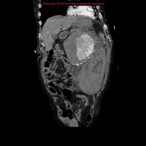 File:Abdominal aortic aneurysm- extremely large, ruptured (Radiopaedia 19882-19921 Coronal C+ arterial phase 31).jpg