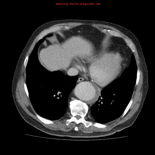 Abdominal aortic aneurysm (Radiopaedia 10122-10660 Axial C+ portal venous phase 5).jpg