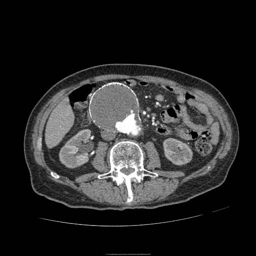 Abdominal aortic aneurysm (Radiopaedia 13341-13340 Axial C+ arterial phase 97).jpg