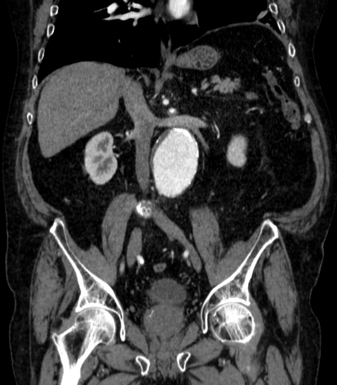 Abdominal aortic aneurysm (Radiopaedia 25855-26001 Coronal C+ arterial phase 36).jpg