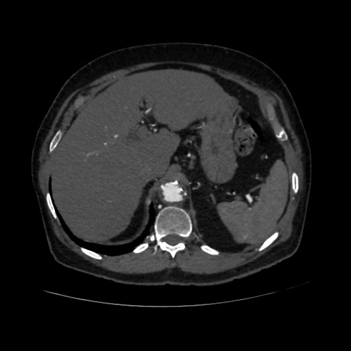 File:Abdominal aortic aneurysm (Radiopaedia 57318-64259 Axial C+ arterial phase 16).jpg