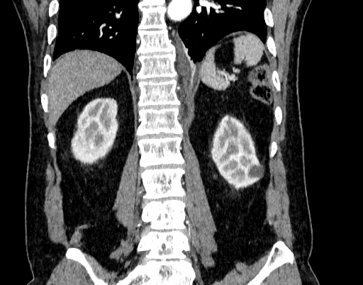 File:Abdominal aortic aneurysm (Radiopaedia 67117-76452 Coronal C+ arterial phase 78).jpg