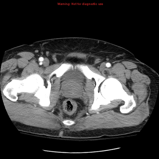 Abdominal aortic aneurysm (Radiopaedia 8190-9038 Axial C+ arterial phase 82).jpg