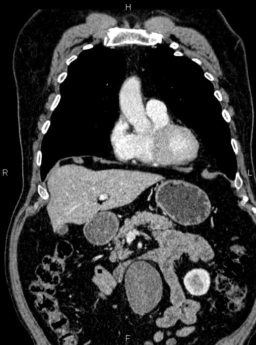 Abdominal aortic aneurysm (Radiopaedia 83094-97462 Coronal renal cortical phase 36).jpg