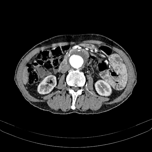 File:Abdominal aortic aneurysm (Radiopaedia 83581-98689 Axial C+ arterial phase 60).jpg