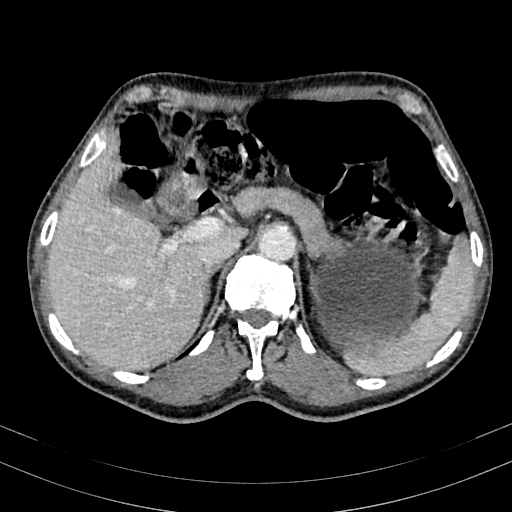 Abdominal aortic aneurysm (Radiopaedia 83581-98689 Axial C+ portal venous phase 29).jpg