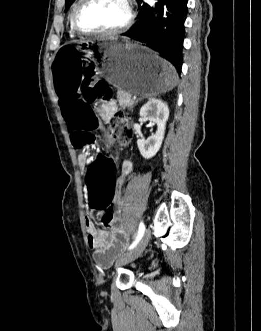Abdominal aortic aneurysm (Radiopaedia 83581-98689 Sagittal C+ arterial phase 80).jpg