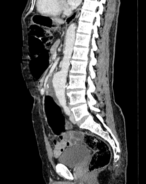 Abdominal aortic aneurysm (Radiopaedia 83581-98689 Sagittal C+ portal venous phase 56).jpg
