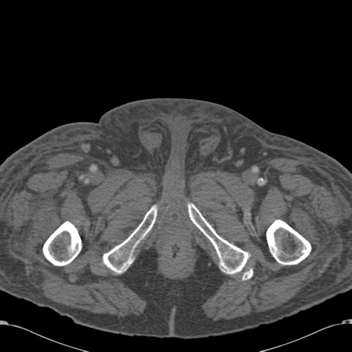 Abdominal hematoma (Radiopaedia 33614-34715 Axial C+ portal venous phase 144).png