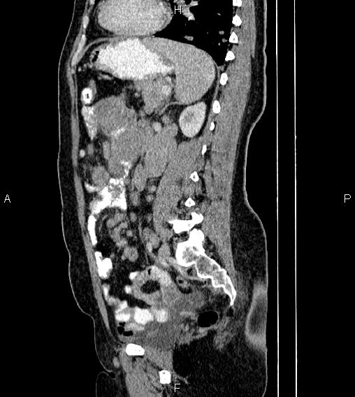 File:Abdominal lymphoma with sandwich sign (Radiopaedia 84378-99704 Sagittal C+ portal venous phase 58).jpg