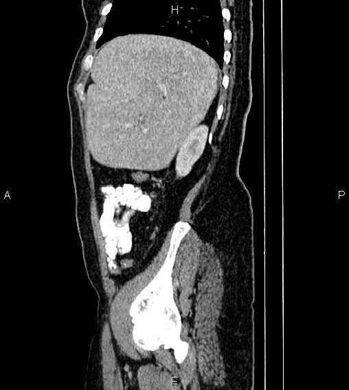 Abdominal lymphoma with sandwich sign (Radiopaedia 84378-99704 Sagittal C+ portal venous phase 75).jpg