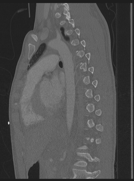 Abdominal multi-trauma - devascularised kidney and liver, spleen and pancreatic lacerations (Radiopaedia 34984-36486 Sagittal bone window 22).png