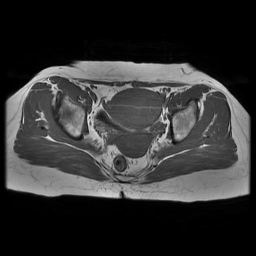 File:Abdominal wall endometriosis (Radiopaedia 83702-98847 Axial T1 11).jpg