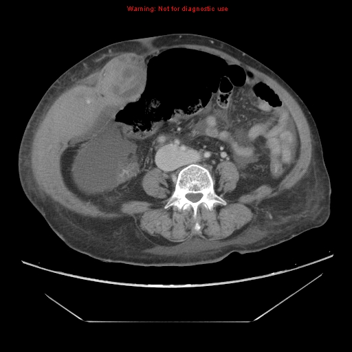 File:Abdominal wall hematoma (Radiopaedia 9427-10112 Axial C+ portal venous phase 64).jpg