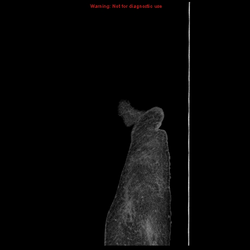 Abdominal wall hematoma (Radiopaedia 9427-10112 Sagittal C+ portal venous phase 2).jpg