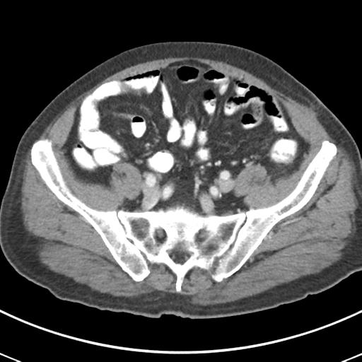 Abdominal wall metastasis from colorectal carcinoma (Radiopaedia 31016-31717 Axial C+ portal venous phase 57).jpg