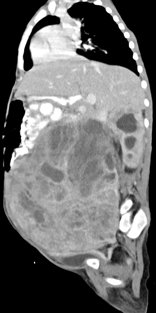 Abdominopelvic rhabdomyosarcoma (Radiopaedia 78356-90984 Sagittal C+ portal venous phase 57).jpg