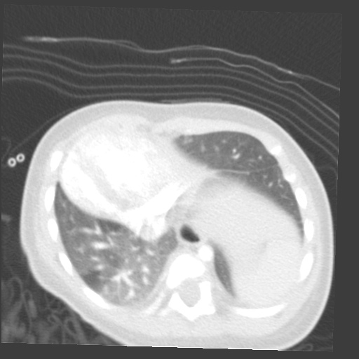 File:Aberrant left pulmonary artery (pulmonary sling) (Radiopaedia 42323-45435 Axial lung window 29).jpg