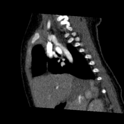 Aberrant left pulmonary artery (pulmonary sling) (Radiopaedia 42323-45435 Sagittal C+ arterial phase 34).jpg