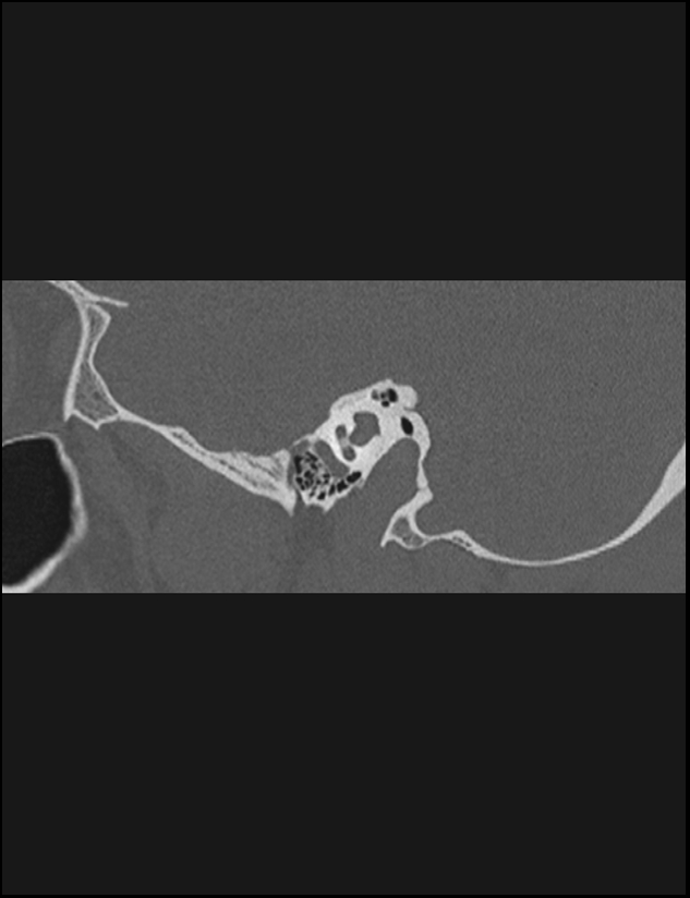Aberrant right internal carotid artery (Radiopaedia 65191-74198 Sagittal non-contrast 58).jpg