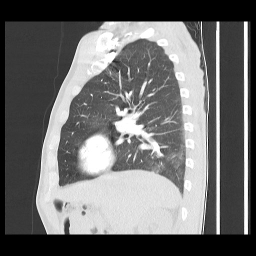 Accessory left horizontal fissure with lingular pneumonia (Radiopaedia 53763-59843 Sagittal lung window 26).jpg