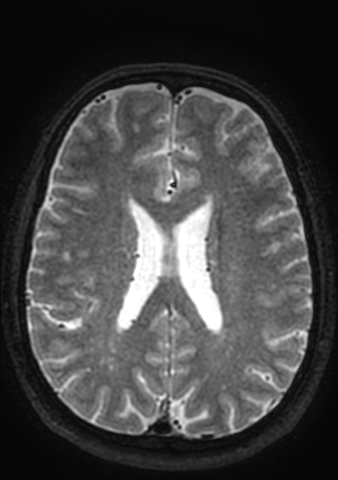 Accessory middle cerebral artery (Radiopaedia 73114-83828 Axial T2 26).jpg