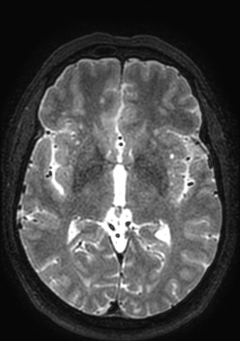 Accessory middle cerebral artery (Radiopaedia 73114-83828 Axial T2 78).jpg