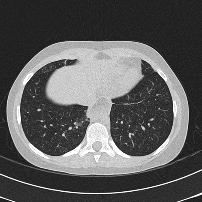 Achalasia (Radiopaedia 14946-14878 Axial lung window 62).jpg