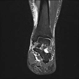 File:Achilles tendon tear (Radiopaedia 77615-89819 Coronal STIR 15).jpg