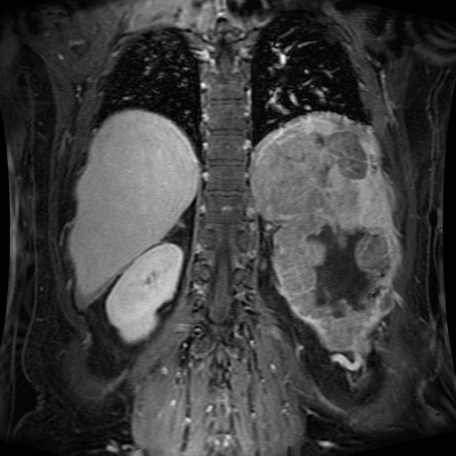 Acinar cell carcinoma of the pancreas (Radiopaedia 75442-86668 Coronal T1 C+ fat sat 54).jpg