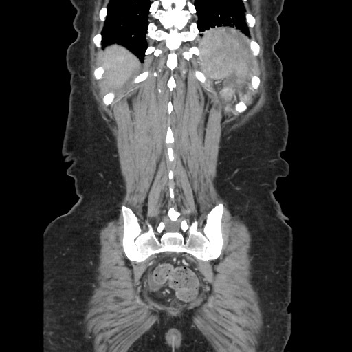 Acinar cell carcinoma of the pancreas (Radiopaedia 75442-86669 Coronal C+ portal venous phase 107).jpg