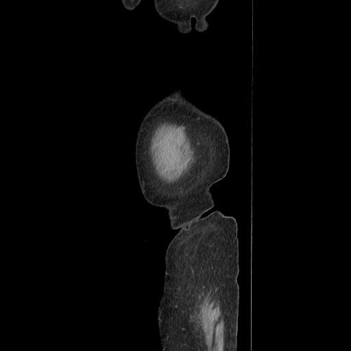Acinar cell carcinoma of the pancreas (Radiopaedia 75442-86669 Sagittal C+ portal venous phase 19).jpg