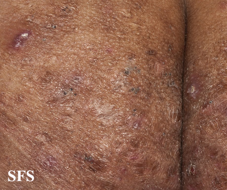 File:Acne (Dermatology Atlas 19).jpg