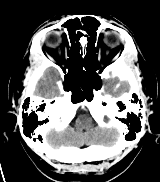 File:Acoustic schwannoma (Radiopaedia 33045-34065 Axial C+ delayed 4).png