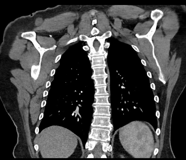 Acromioclavicular joint cyst (Radiopaedia 58455-65610 Coronal C+ arterial phase 106).jpg