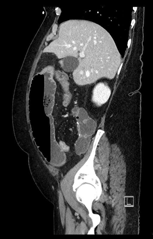 Active Crohn disease (Radiopaedia 59394-66750 Sagittal C+ portal venous phase 43).jpg