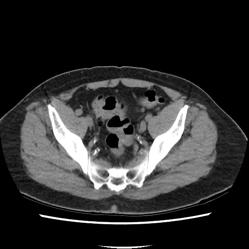 File:Active colonic bleed on CT (Radiopaedia 49765-55025 Axial non-contrast 69).jpg