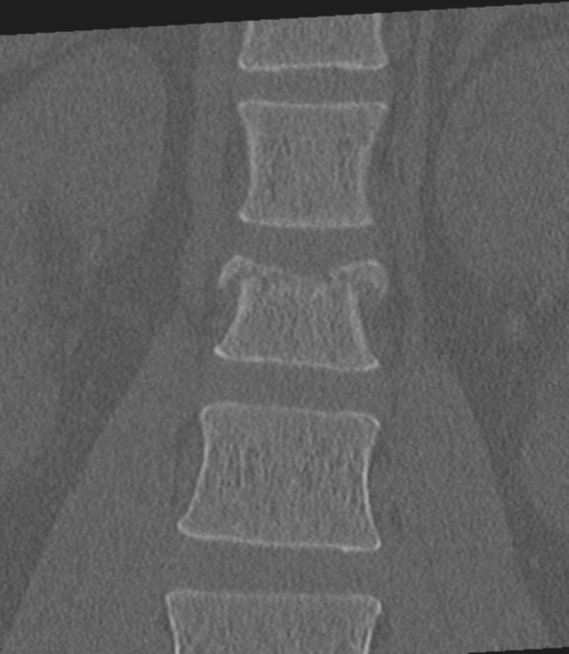 Acute L1 burst compression fracture (Radiopaedia 34430-35755 Coronal bone window 17).png